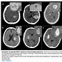 Image result for Intracerebral Hemorrhage CT