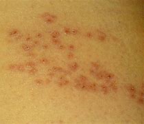 Image result for Diagnose Skin Rash