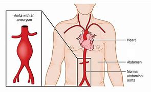 Image result for Abdominal Aortic Aneurysm Heart Beat