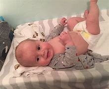Image result for Baby Born with Hydrocephalus