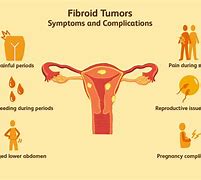 Image result for Cyst or Fibroid