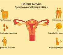 Image result for Fibroid Tumors
