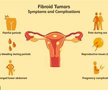Image result for Uterine Fibroids in Uterus Nursing Diagnosis
