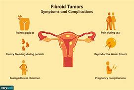 Image result for Uterine Fibroids Blood Clots
