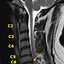 Image result for Anterolisthesis Cervical Spine