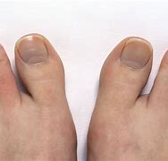Image result for Arthritis On Toes