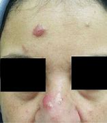 Image result for Alpha 1 Skin Nodules