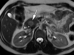 Image result for Pancreatic Cyst MRI