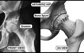 Image result for Wherre Can Bone Spur Grow Hip