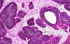 Image result for Papilloma On Neck