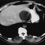 Image result for 6 Cm Tumor Picture