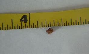 Image result for How Big Is 5 mm Kidney Stone