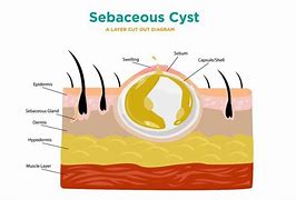 Image result for Cyst 10Cm