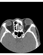 Image result for High Grade Dysplasia in Sinonasal Papilloma