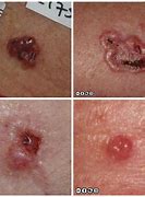 Image result for Warts and Skin Cancer