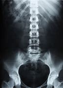 Image result for Lumbar Spine X-ray