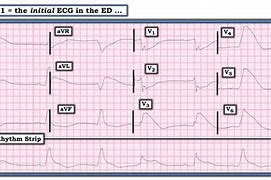 Image result for CPR ECG Reading