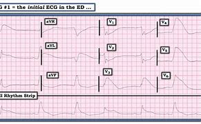 Image result for EKG with Lucas CPR