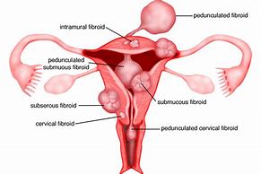 Image result for Posterior Fundal Fibroid