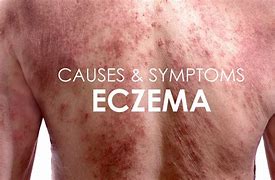 Image result for What Does Plaque Eczema Look Like