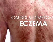 Image result for Eczema Rash Symptoms
