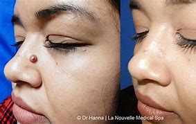 Image result for Wart Remover On Mole Before and After