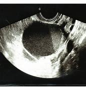Image result for ovary dermoid cysts ultrasound