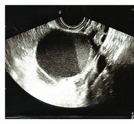 Image result for 13 Cm Ovarian Cyst