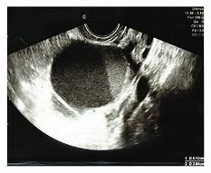 Image result for 10 Cm Cyst On Ovaries Ultrasound