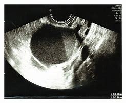 Image result for Ovarian Cyst with Debris