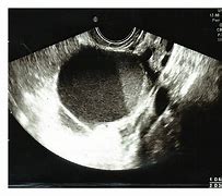Image result for 6 Cm Ovarian Cyst