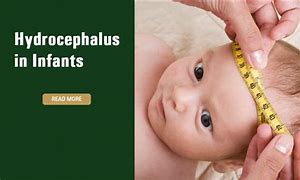 Image result for Hydrocephalus