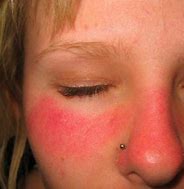 Image result for Sun Burn First-Degree Burn