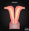 Image result for Uterus Didelphys. Size: 95 x 100. Source: radiopaedia.org