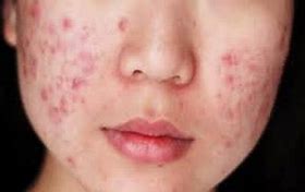 Image result for Acne Face