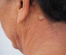 Image result for Sebaceous Cyst Neck