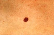 Image result for Blood Skin Tags