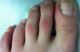 Image result for Gottron Papules