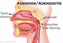 Image result for adenoidel
