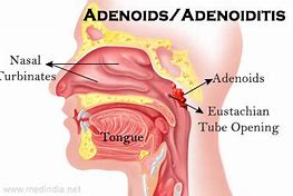 Image result for adenoidew