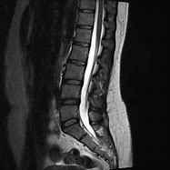 Image result for Back Brace Support Lumbar Spine