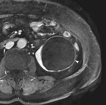 Image result for Haemoragic Renal Cyst MRI