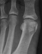 Image result for Wart in Feet