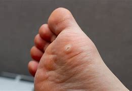 Image result for Wart Hole Foot