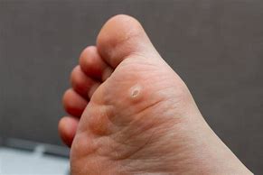 Image result for Foot Warts
