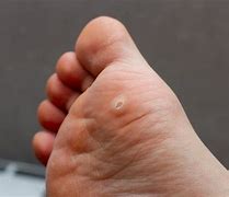 Image result for Plantar Warts On Feet