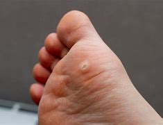 Image result for Feet Warts