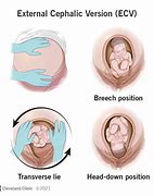 Image result for Cephalic Position