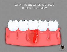 Image result for Swollen Bleeding Gums