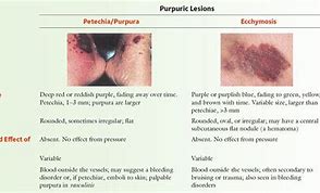 Image result for Petechiae and Purpura